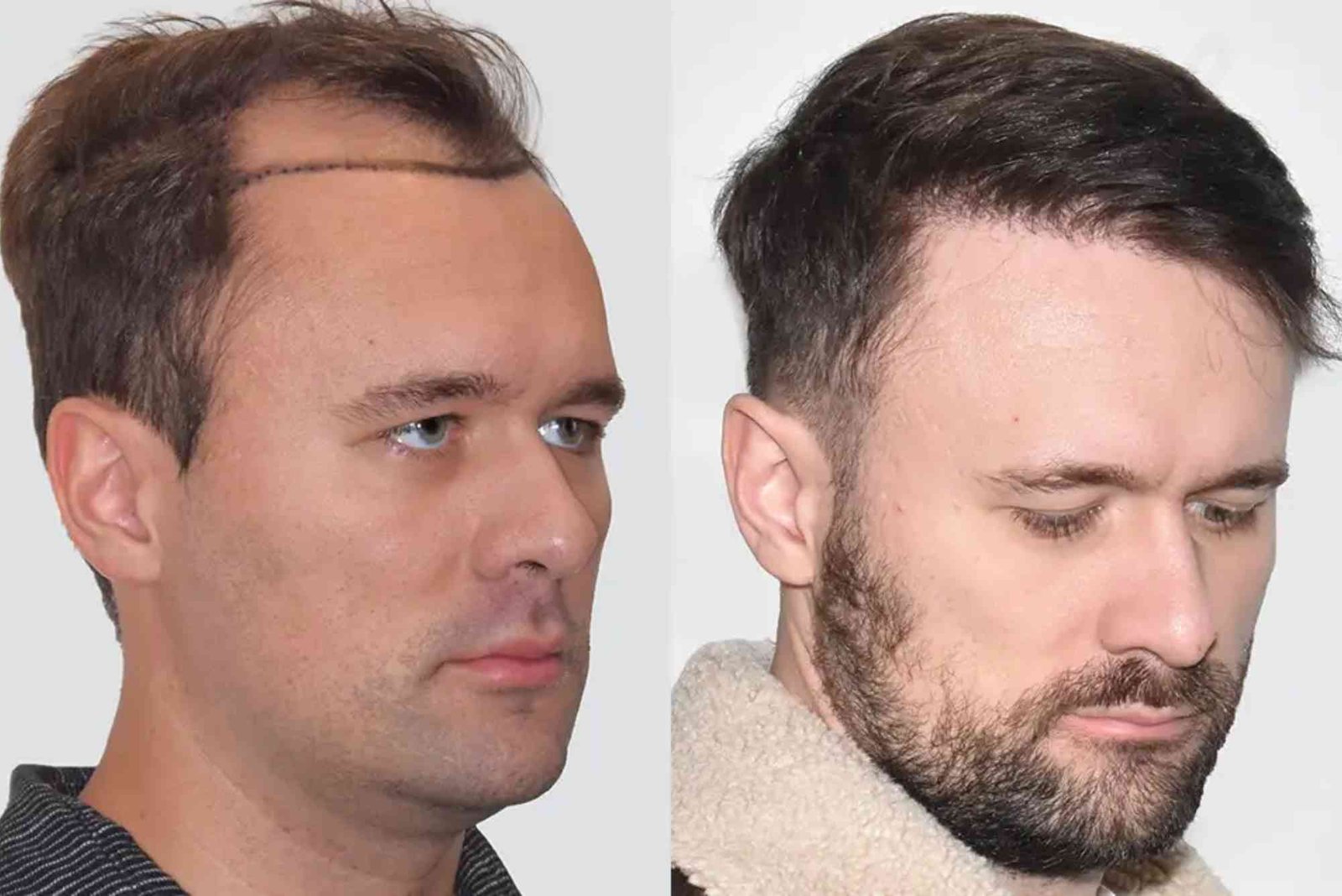 Hair Transplant Turkey